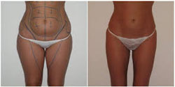 chirugie esthetique ventre 77100,anches 77100,liposuccion complete 77100,culotte de cheval 77100 liposuccion pas cher 77100,meilleur chirurgien 77100
