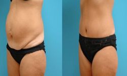 abdominoplastie pas cher 91,abdominoplastie tarif essonne chirurgien esthetique lifting ventre 91