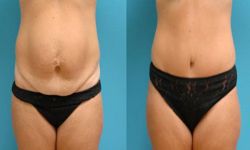 chirugie esthetique ventre 91,mini lifting ventre 91,abdominoplastie essonne,mini lifting ventre 91 abdominoplastie pas cher 91,meilleur chirurgien 91
