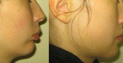 génioplastie prix 91,génioplastie 91