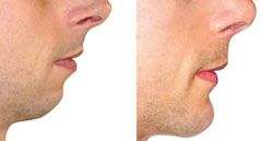 génioplastie 91,génioplastie essonne chirurgien esthetique menton 91