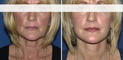 chirugie esthetique visage 91410 lifting cervico facial pas cher 91410,meilleur chirurgien91410