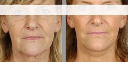 lifting cervico facial 91410,lifting cervico facial dourdan chirurgien esthetique visage 91410