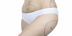 liposuccion cuisse 91,liposuccion silhouette complete 91,lipostructure culotte de cheval 91 lipofine silhouette 91,liposuccion anches essonne