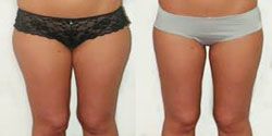 liposuccion 91,liposuccion essonne chirurgien esthetique cuisse,ventre 91,anches 91,liposuccion complete 91,culotte de cheval 91