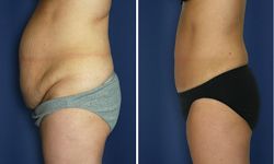 abdominoplastie 92150 suresnes abdominoplastie prix 92150,abdominoplastie 92150