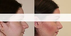 rhinoplastie prix 92110,rhinoplastie 92110