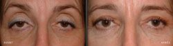 chirugie esthetique paupières 93700 blépharoplastie pas cher 93700,meilleur chirurgien93700
