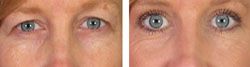 blépharoplastie 93700,blépharoplastie drancy chirurgien esthetique paupières 93700