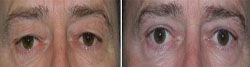blépharoplastie 93700 drancy blépharoplastie prix 93700,blépharoplastie 93700