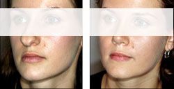 chirugie esthetique menton 93130 génioplastie pas cher 93130,meilleur chirurgien93130