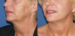 lifting cervico facial 93700,lifting cervico facial drancy