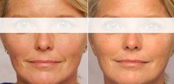 lifting cervico facial 93430 villetaneuse lifting cervico facial prix 93430,lifting cervico facial 93430