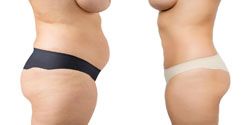 lipoaspiration graisse 93130 noisy-le-sec liposuccion prix 93130,liposuccion 93130