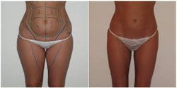 chirugie esthetique ventre 93130,anches 93130,liposuccion complete 93130,culotte de cheval 93130 liposuccion pas cher 93130,meilleur chirurgien 93130