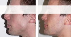 chirurgie nez 93130,rhinoplastie nez noisy-le-sec rhinoplastie 93130,rhinoplastie noisy-le-sec