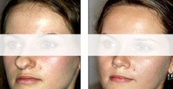 rhinoplastie 93130,rhinoplastie noisy-le-sec chirurgien esthetique nez 93130