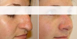 chirugie esthetique nez 94420 rhinoplastie pas cher 94420,meilleur chirurgien94420