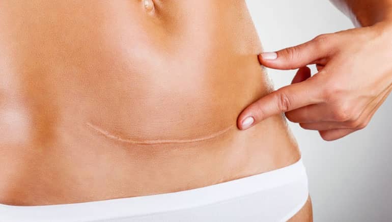 abdominoplastie tunisie prix