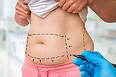 abdominoplastie pas cher tunisie tarif