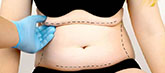 un séjour esthétique pour une abdominoplastie en tunisie