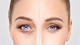 prix blépharoplastie tunisie