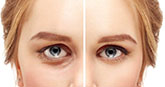 blépharoplastie paupières tunisie