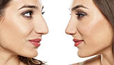 avis rhinoplastie tunisie